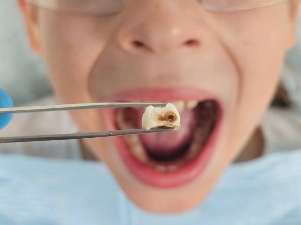 Best Emergency Tooth Extraction in Humboldt, KS